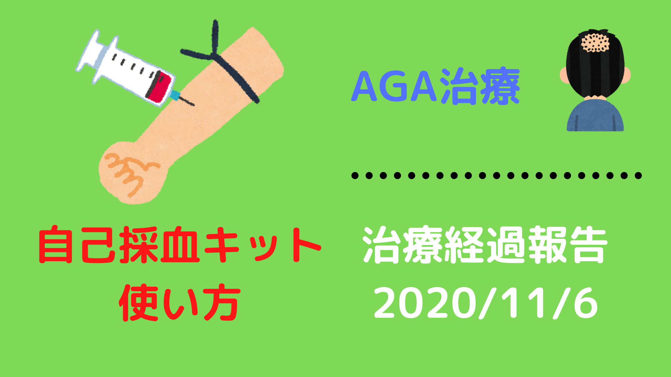 AGA治療　経過報告　自己採血キット使い方